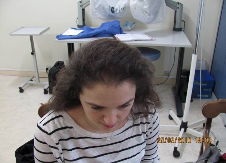 cas 10 après greffe cheveux femme