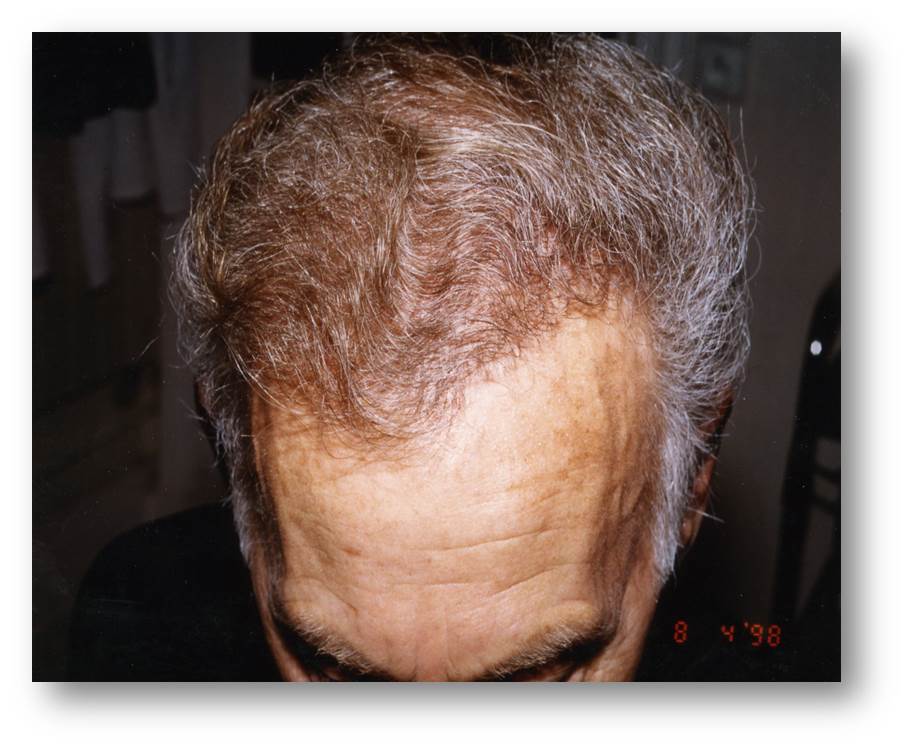 cas 8, homme après une séance de 1200 implants capillaires
